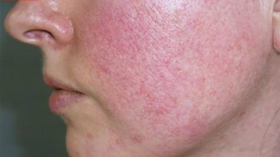 Da yếu do sử dụng kem trị nám cấp tốc