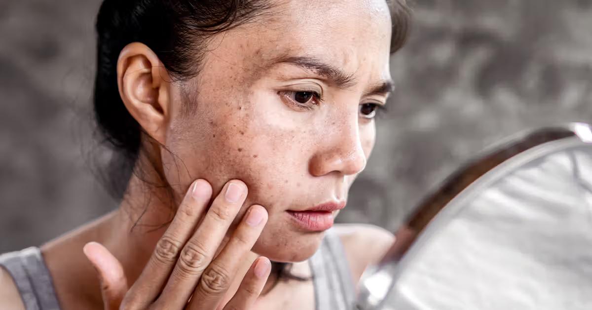 Trước khi điều trị sẹo rỗ cần xem đó là dạng sẹo nào