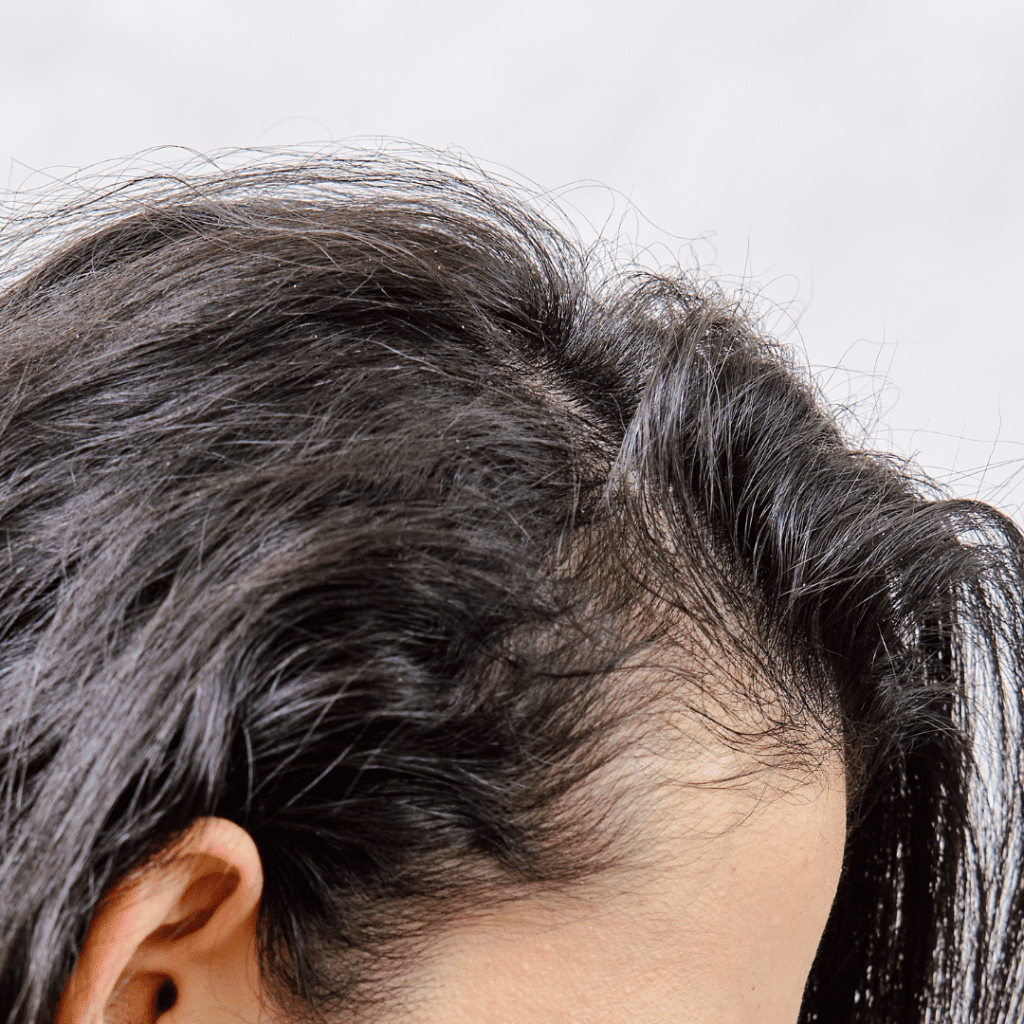 Thiếu kẽm gây ra tình trạng rụng tóc dần 