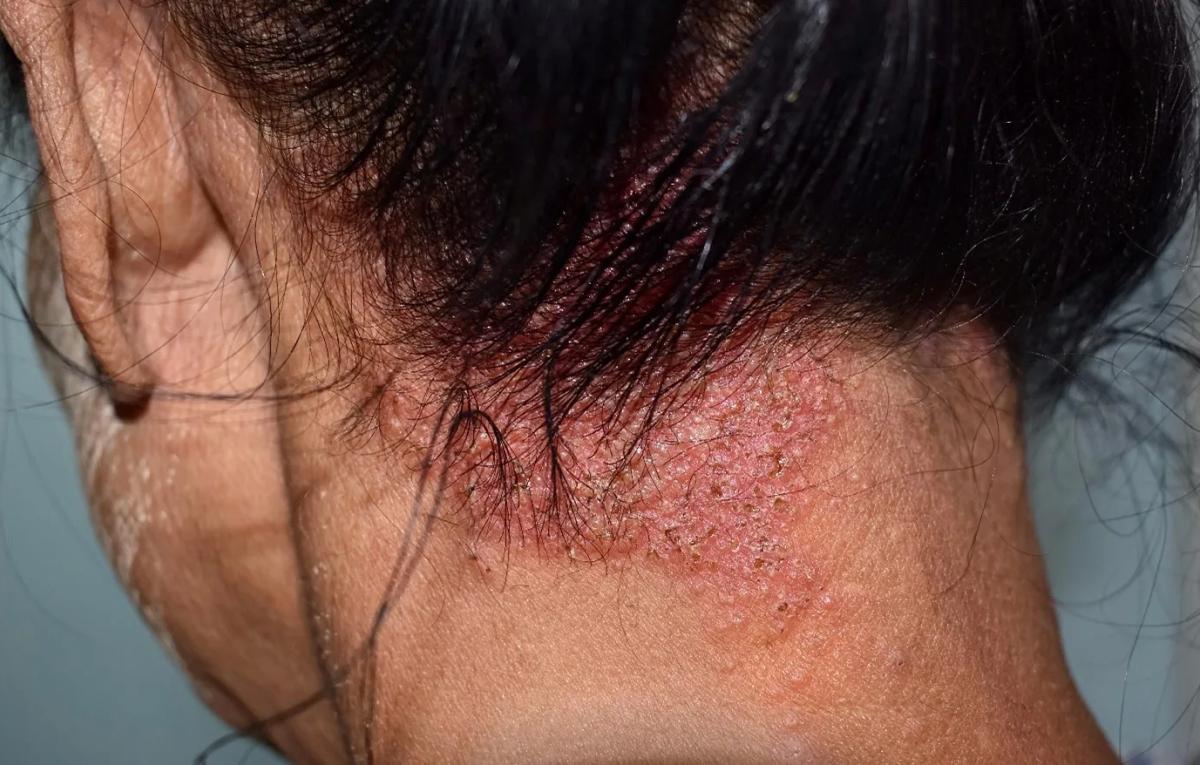 Tình trạng bệnh viêm da đầu 