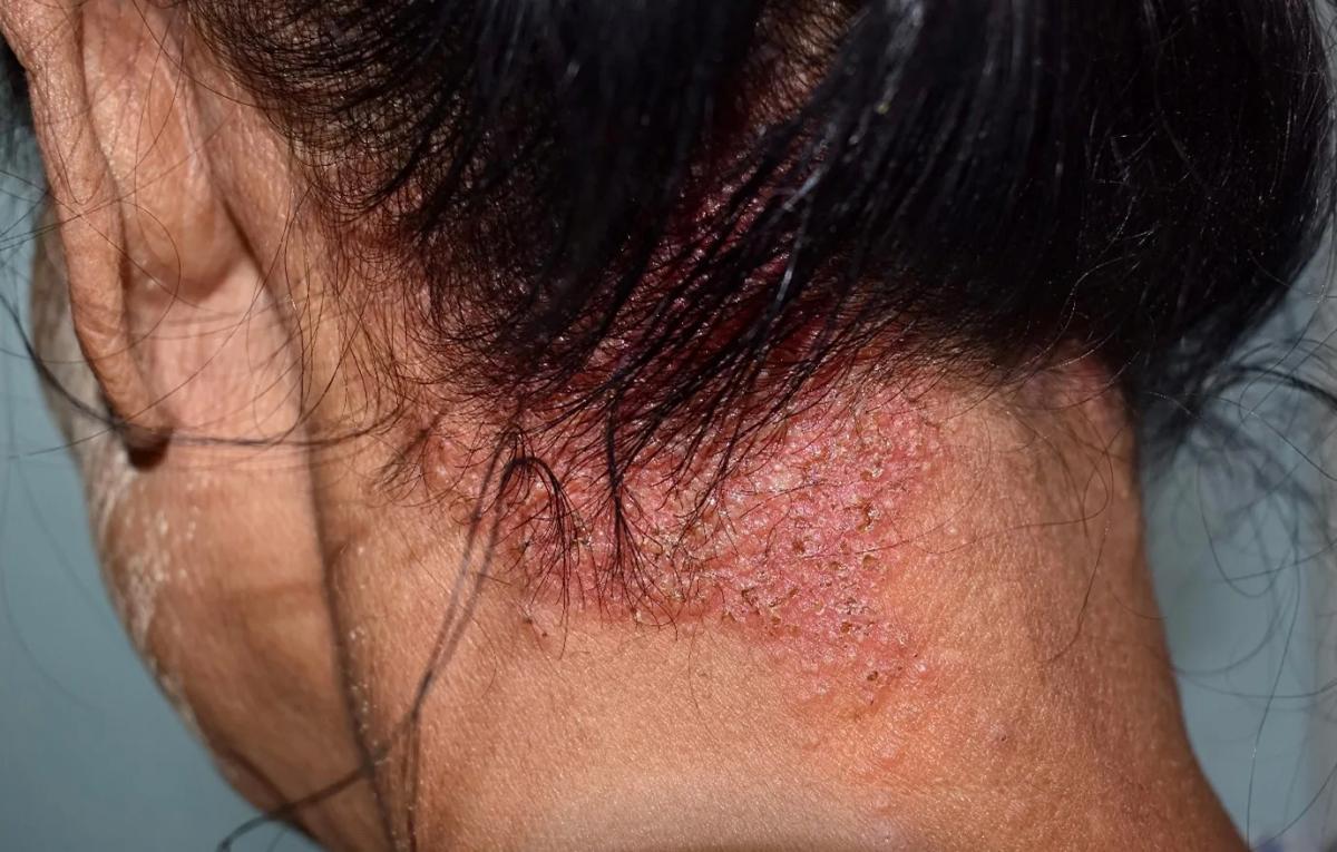 Tình trạng bệnh viêm da đầu