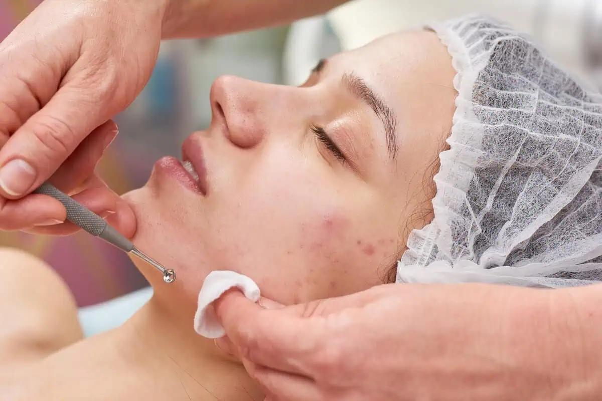 Điều trị mụn bằng phác đồ của bác sĩ