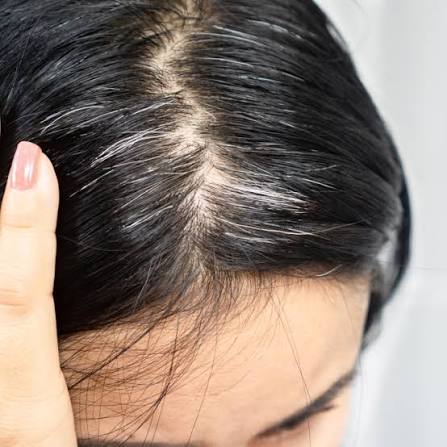 Thiếu Vitamin D gây rụng tóc 