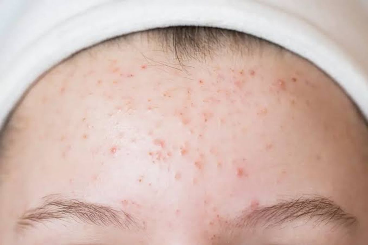 Mụn viêm ở vùng trán 