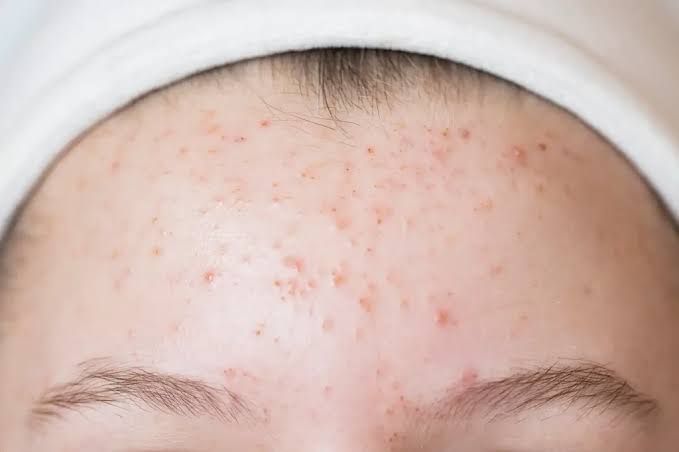 Mụn viêm ở vùng trán
