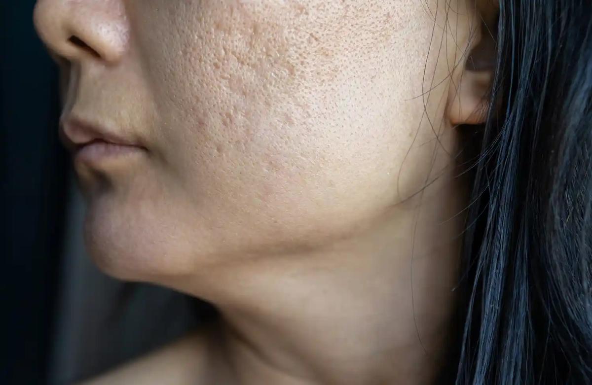 Sẹo đáy nhọn ở vùng má