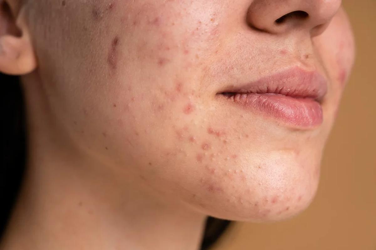 Mụn viêm ở vùng cằm 