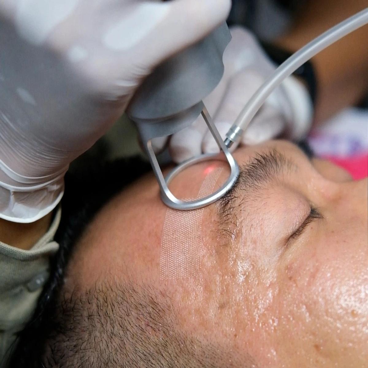 Phương pháp Laser CO2 Fractional