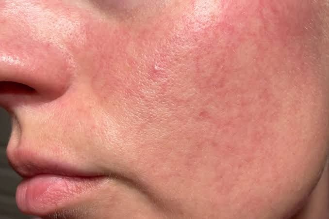 Tình trạng mụn trứng cá đỏ gây giãn mao mạch