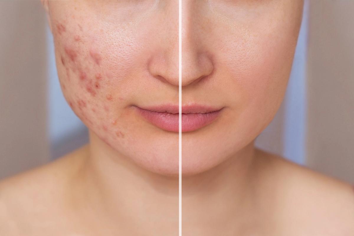 Sử dụng  isotretinoin điều trị mụn 