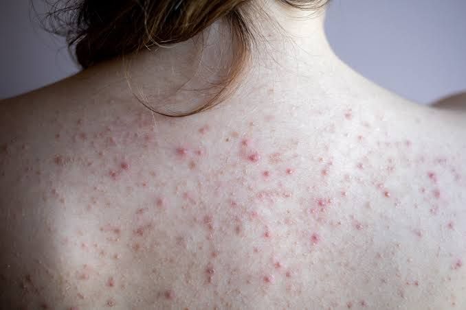 Mụn lưng dạng mụn viêm