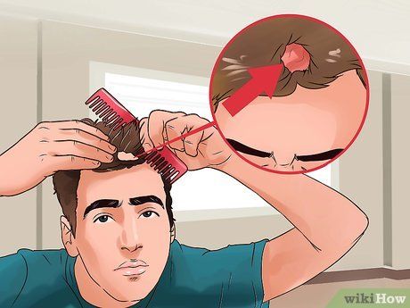 Rụng tóc do nấm da đầu 