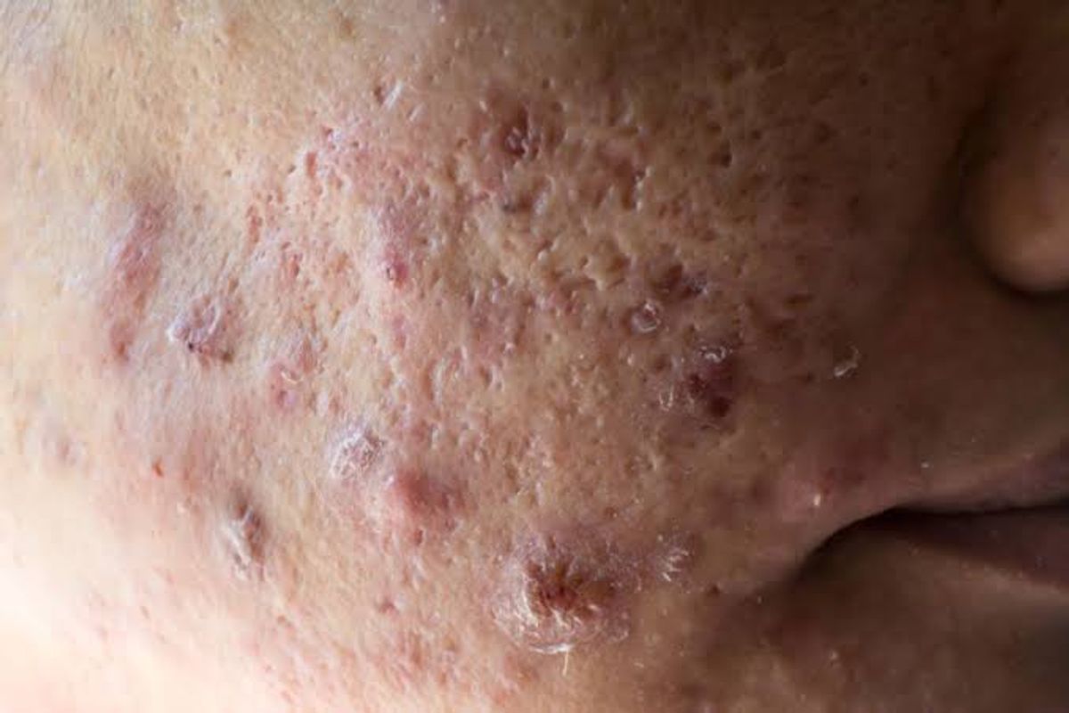 Mụn bọc xuất hiện theo cụm 