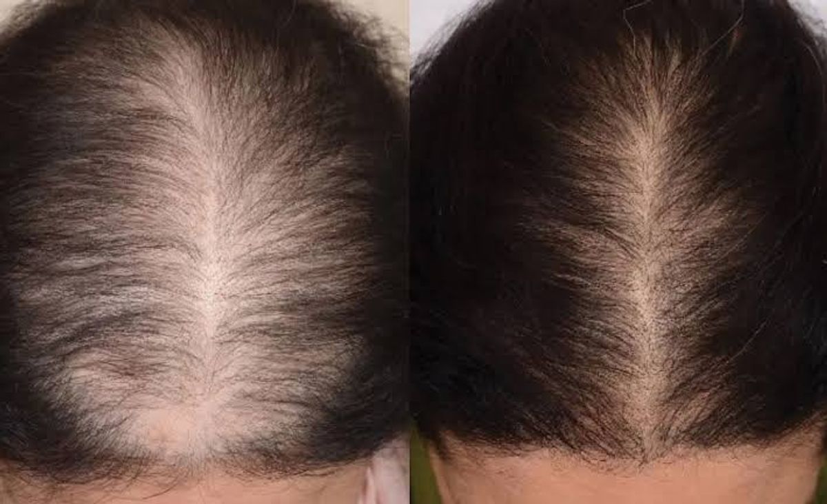 Rụng tóc do nội tiết androgen ở phụ nữ độ tuổi trung niên 