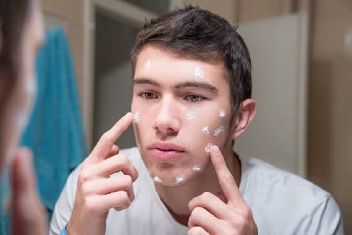 Điều trị mụn ở nam giới 
