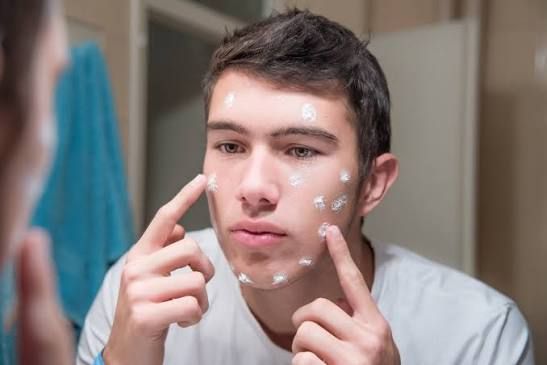 Điều trị mụn ở nam giới