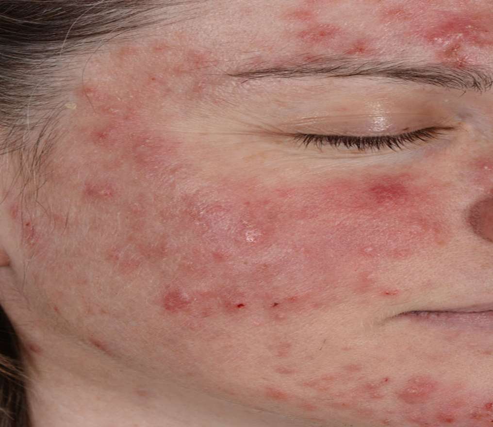 Da nhiễm corticoid do dùng mỹ phẩm chứa corticoid thời gian dài