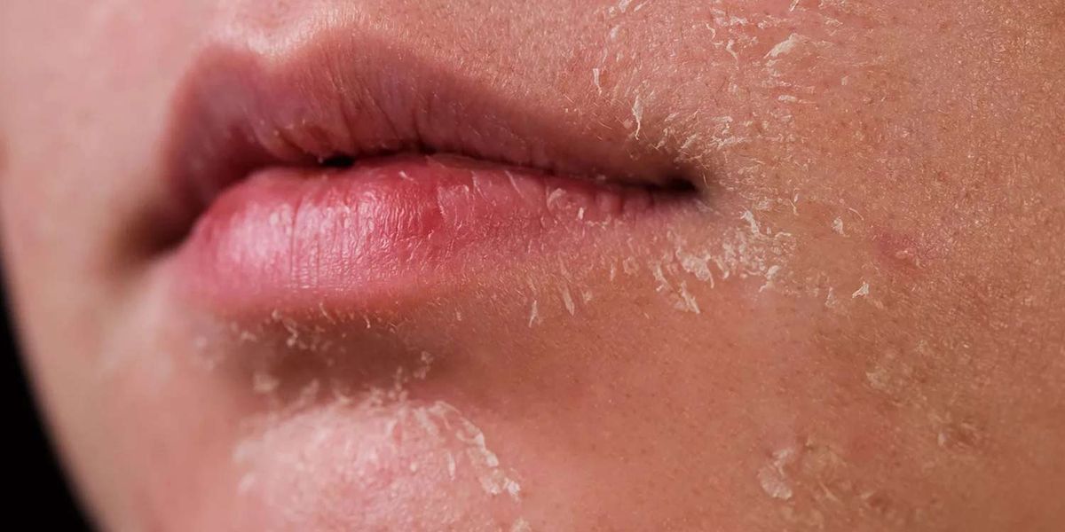 Điều trị mụn có nên uống isotretinoin gây khô da
