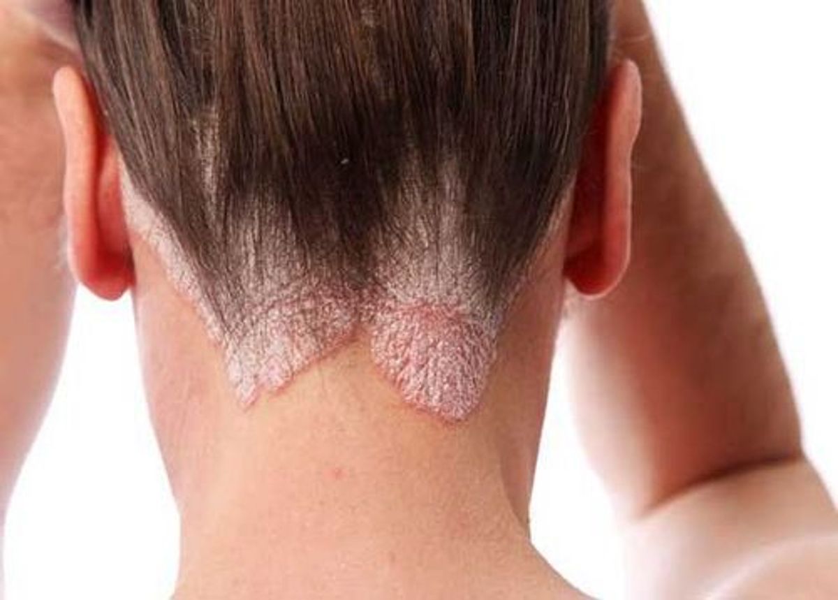 Vảy nến ở da đầu