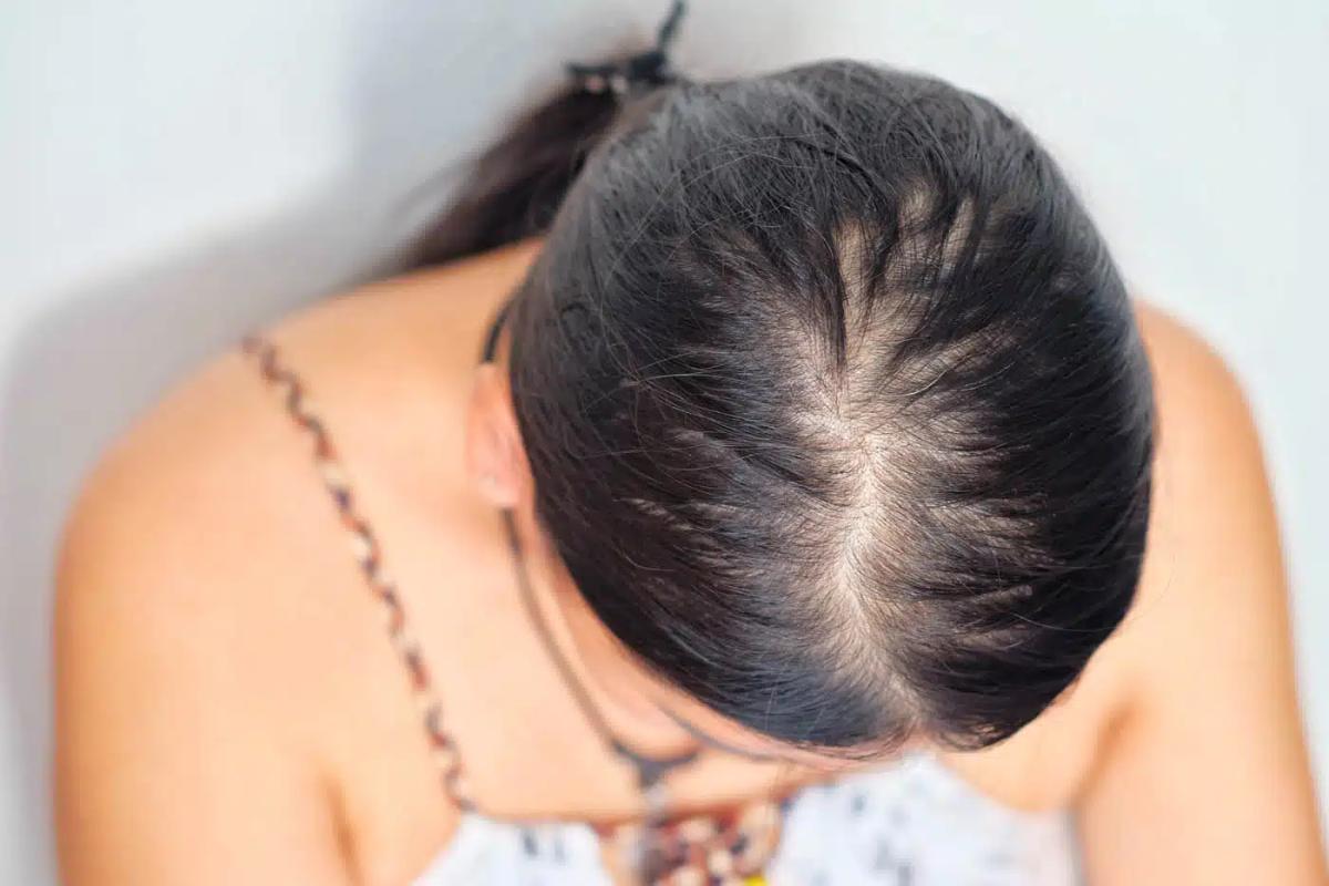 Tình trạng rụng tóc sau sinh khiến tóc thưa dần