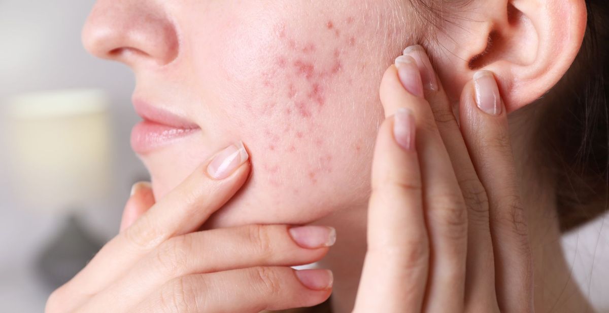 Điều trị mụn nội tiết từ nguyên nhân gốc rễ