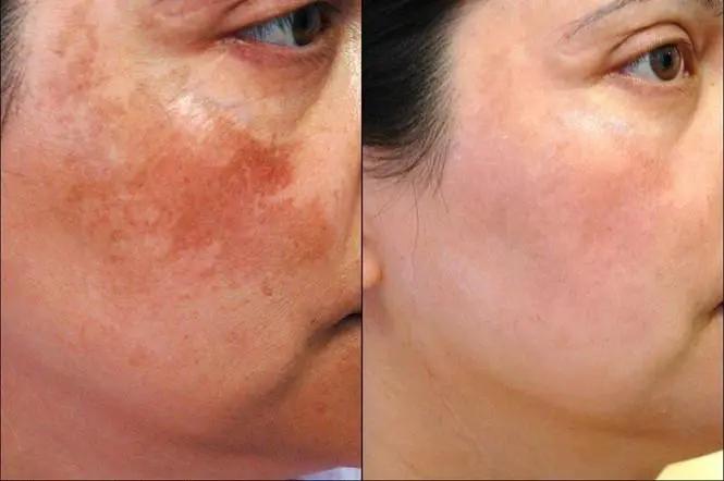 Hiệu quả sau quá trình điều trị nám bằng công nghệ LIOB 660