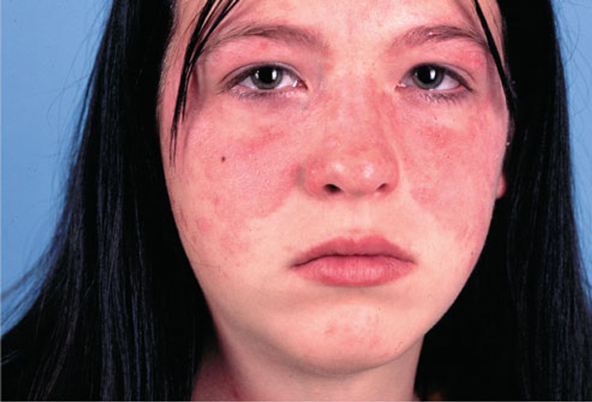 Bệnh lupus ban đỏ