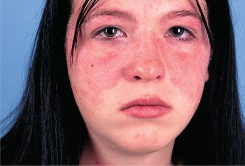 Bệnh lupus ban đỏ