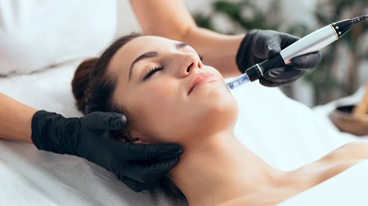 Điều trị sẹo rỗ lâu năm bằng phương pháp mài da