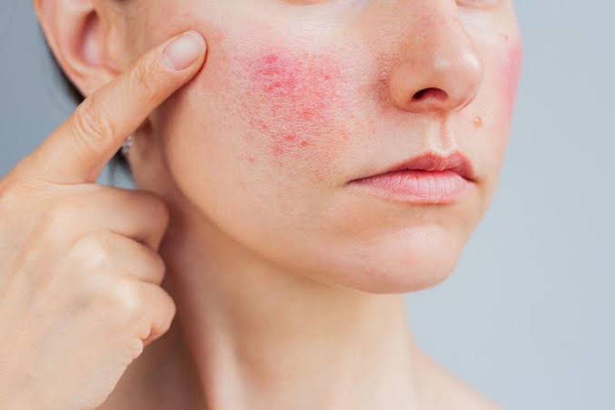 Tình trạng mụn trứng cả đỏ gây giãn mao mạch