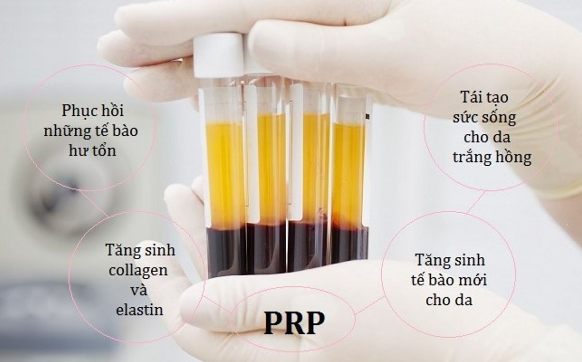 Hiệu quả của PRP khi điều trị 