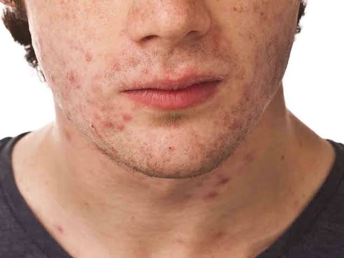 Mụn viêm ở nam giới 