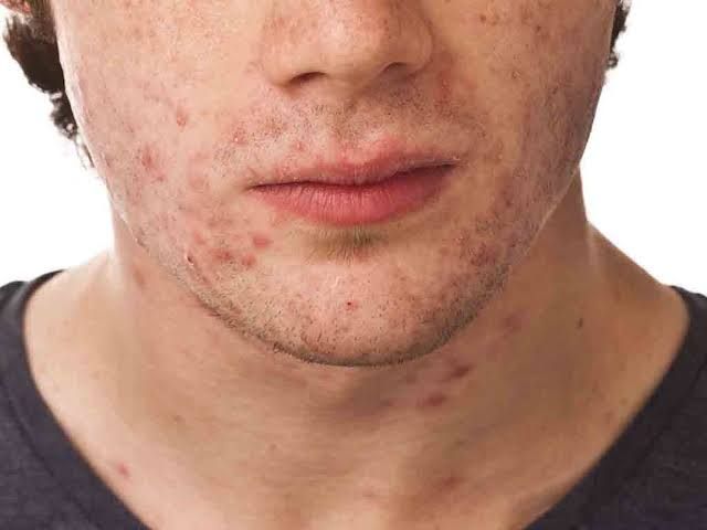 Mụn viêm ở nam giới