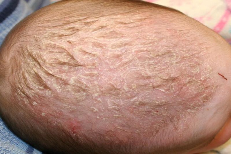 Viêm da tiết bã vùng đầu trẻ sơ sinh