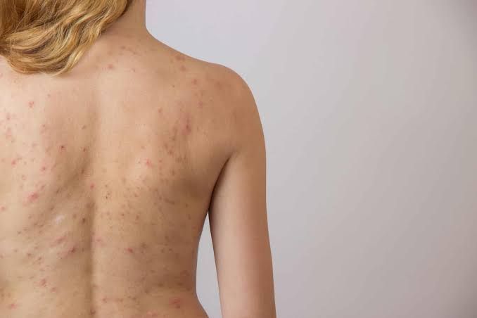 Mụn lưng xuất hiện rải rác