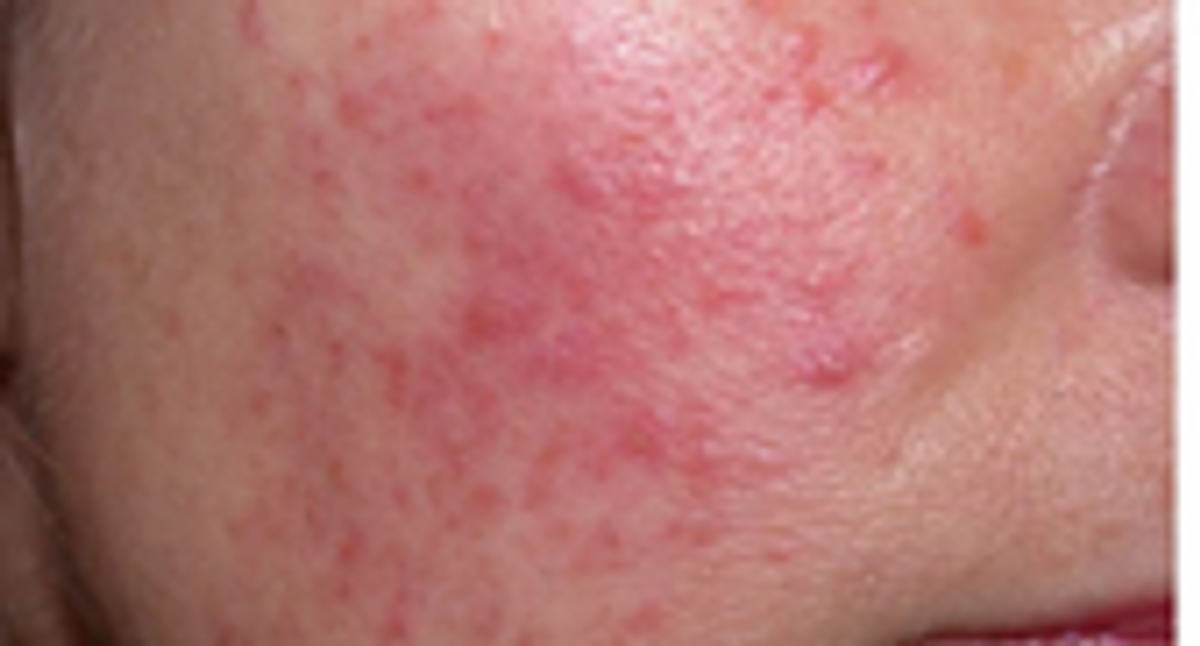 Da nhiễm Corticoid 