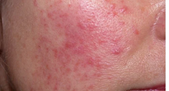 Da nhiễm Corticoid