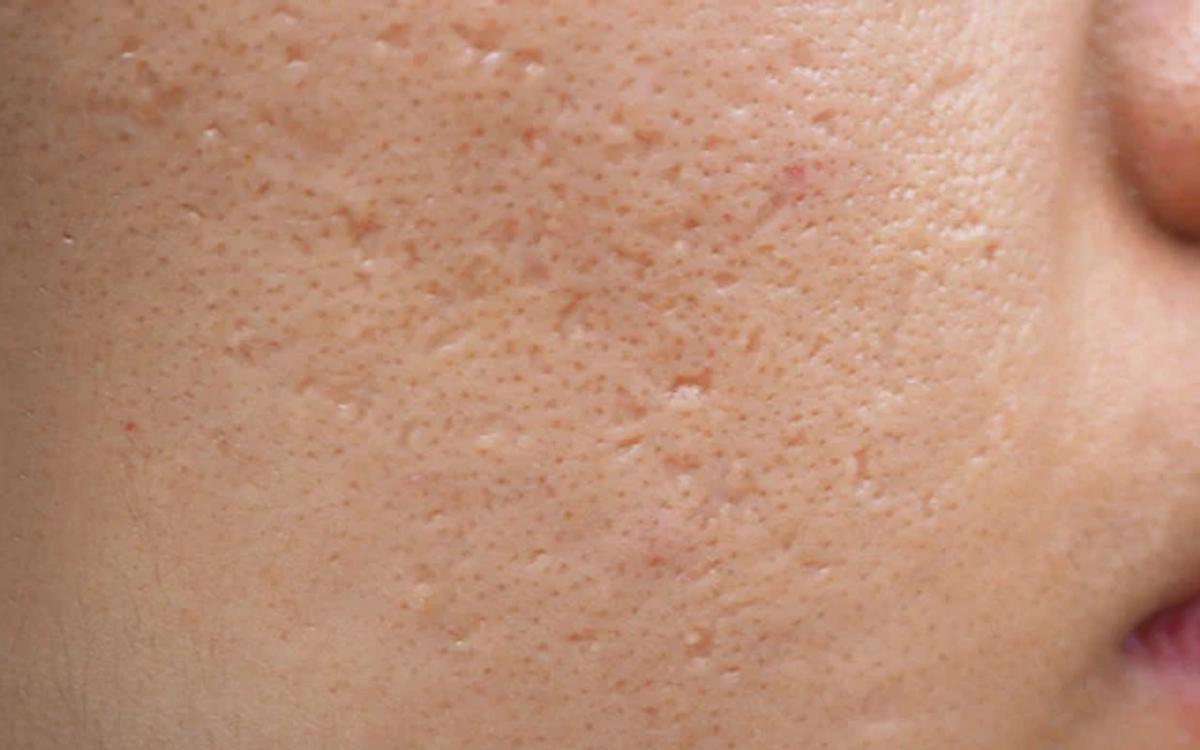 Sẹo đáy nhọn lâu năm trên