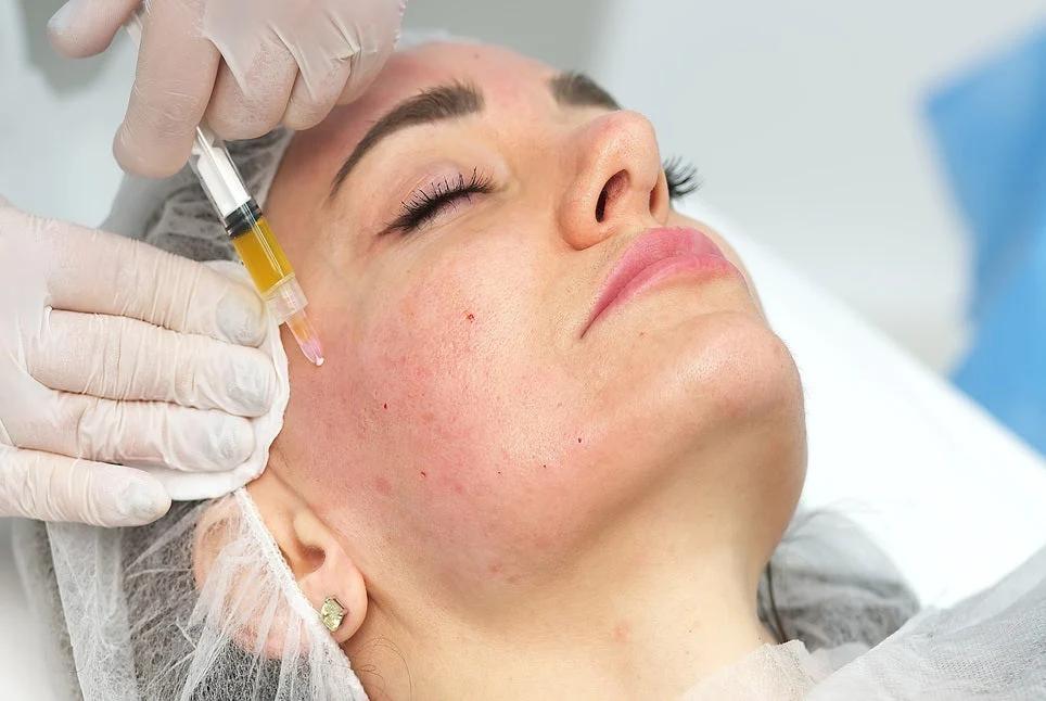 Kỹ thuật tiêm vi điểm PRP