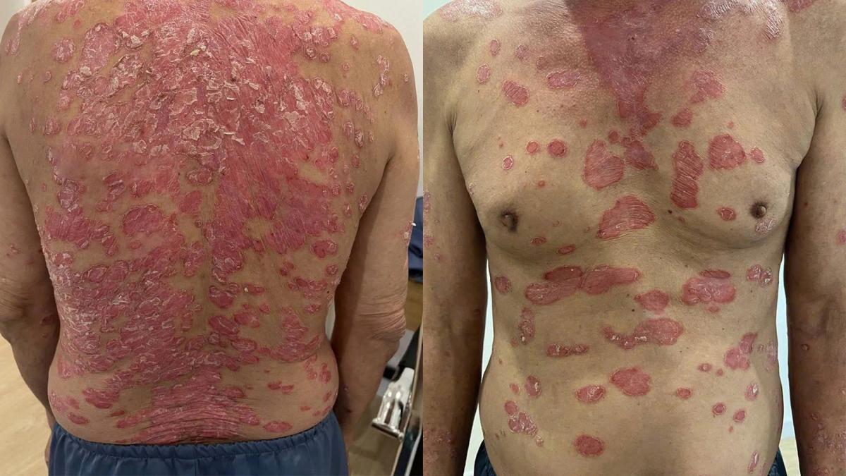Hình ảnh vảy nến điển hình