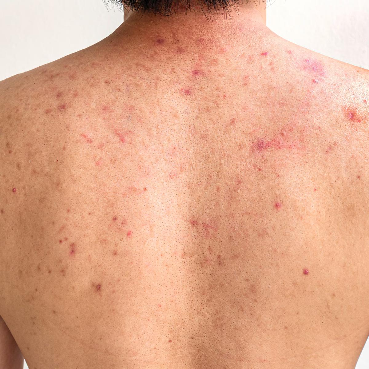 Peel tao điều trị mụn lưng