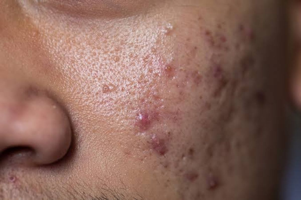 Tình trạng mụn viêm ở nam giới 