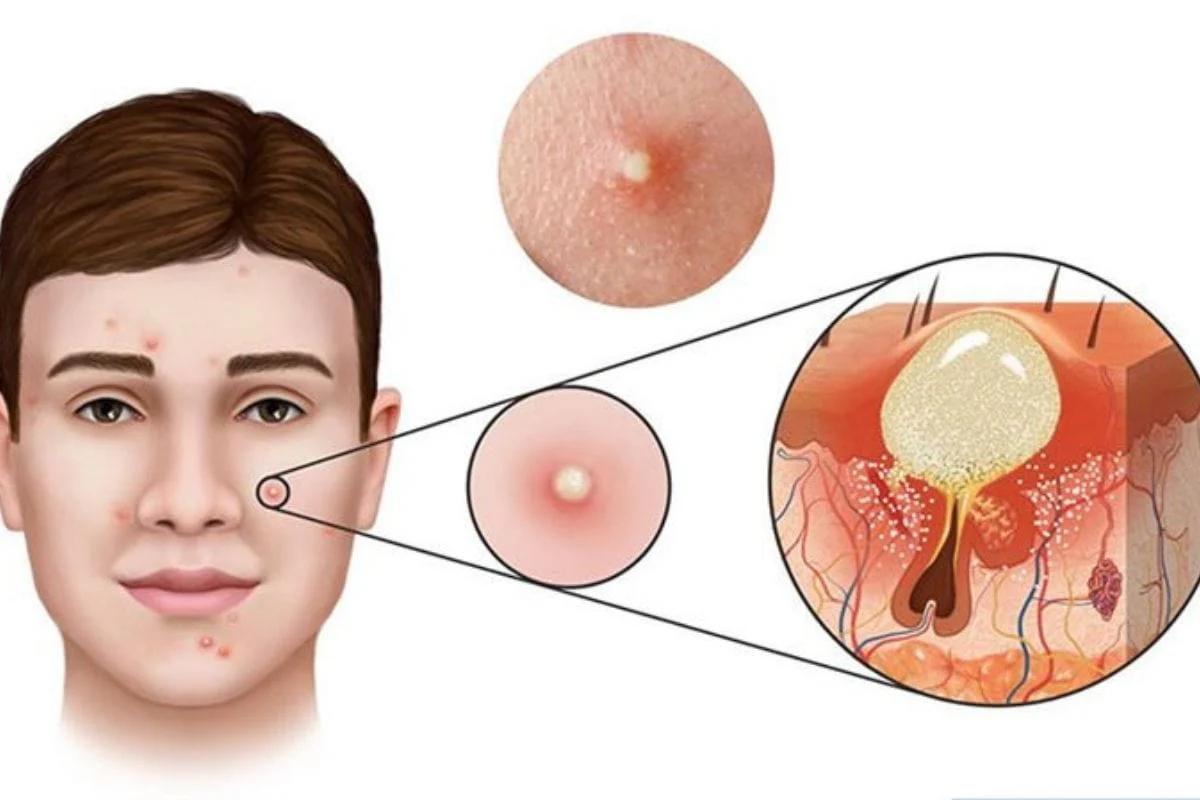 Hình ảnh mụn viêm phát triển 