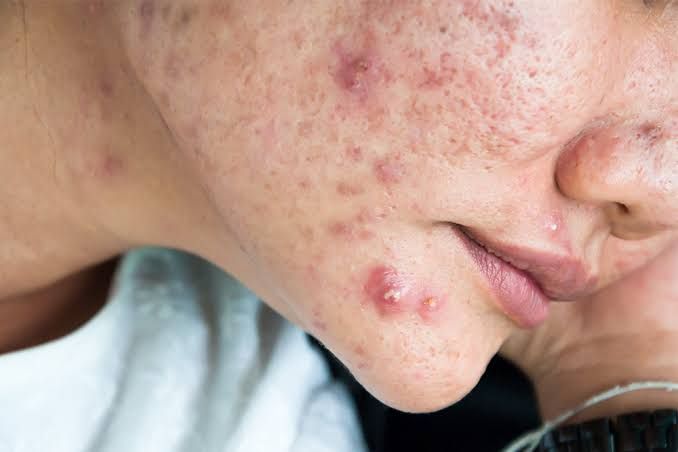 Chườm lạnh để làm giảm tình trạng sưng