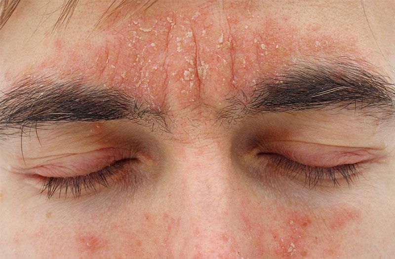 Viêm da tiết bã vùng trán