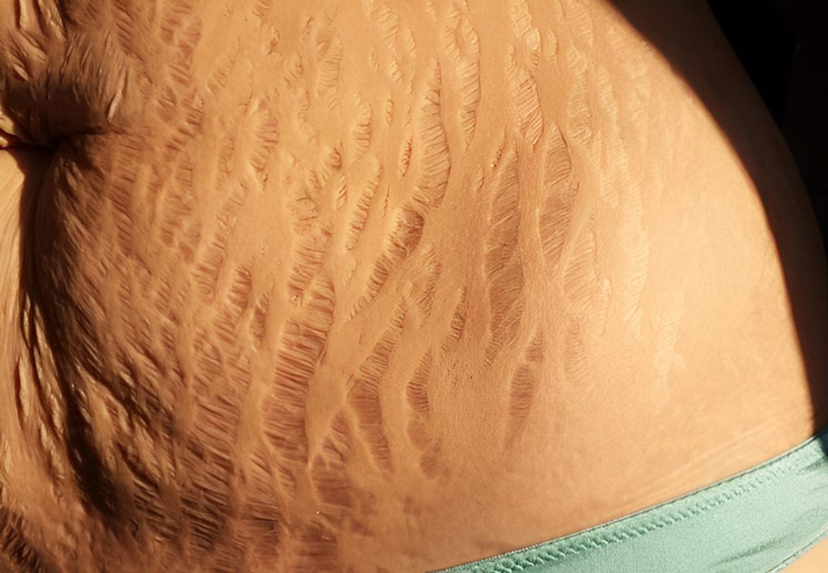 Rạn da ở phụ nữ mang thai