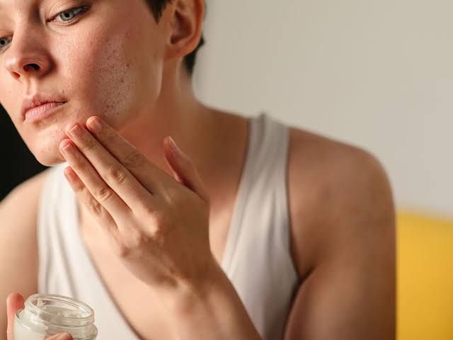 Chăm sóc da sau khi lấy nhân mụn y khoa