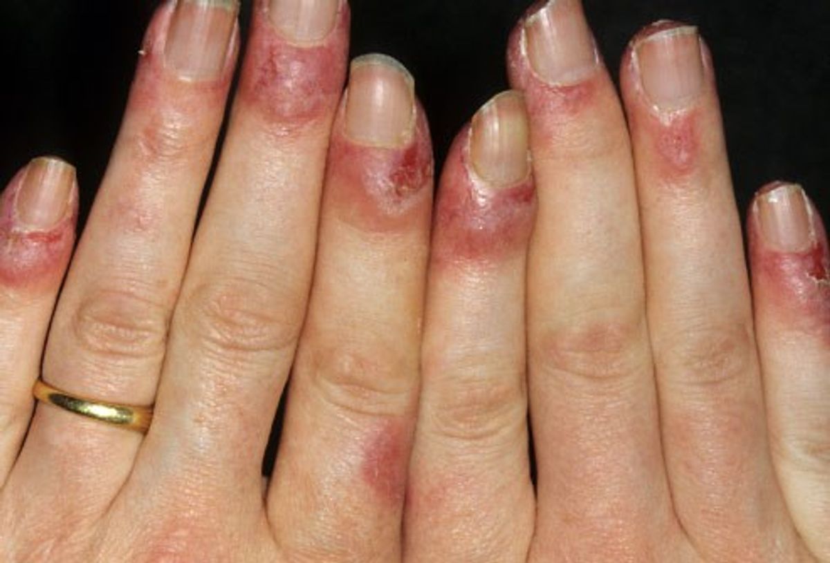 Tổn thương các khớp ở bệnh nhân Lupus ban đỏ