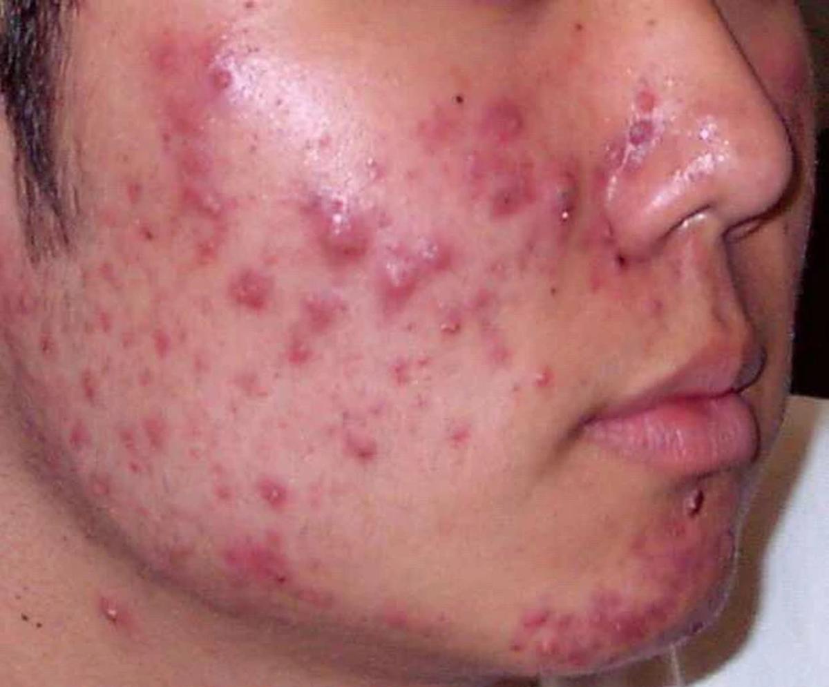 Skincare sai cách khiến tình trạng mụn tệ hơn