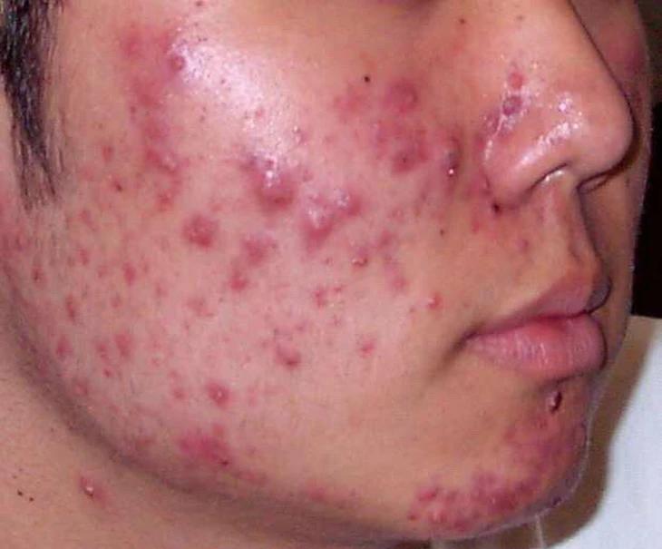 Skincare sai cách khiến tình trạng mụn tệ hơn